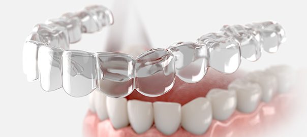 "Can Aligners Fix Midline Shift or Crossbite? Mydent’s Answer"