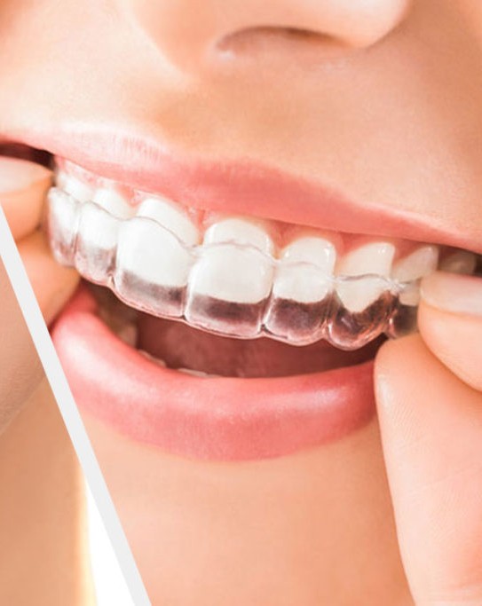 "What to Expect in the First Week of Wearing Mydent Aligners"